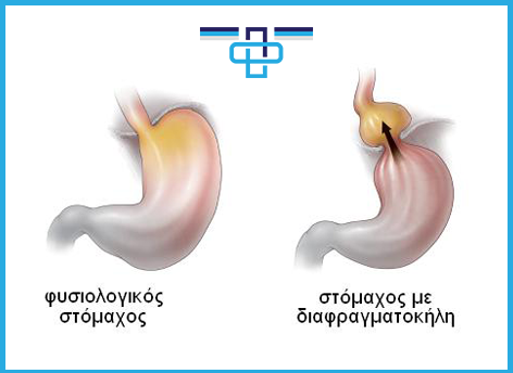 hiatal hernia