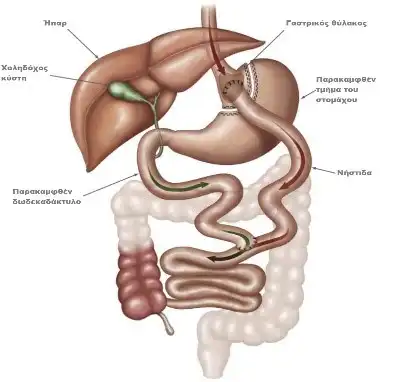 gastriki-parakampsi