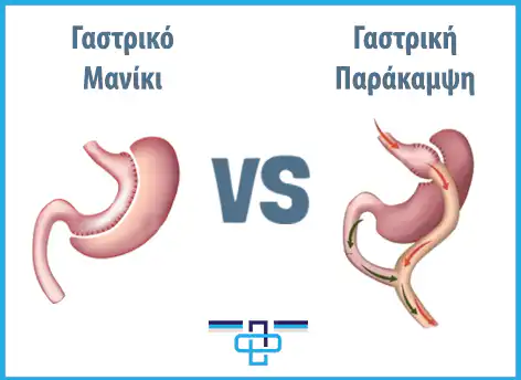 Επιμήκης γαστρεκτομή ή γαστρική παράκαμψη