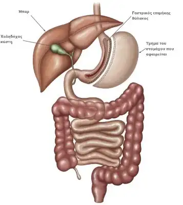 gastriko-maniki