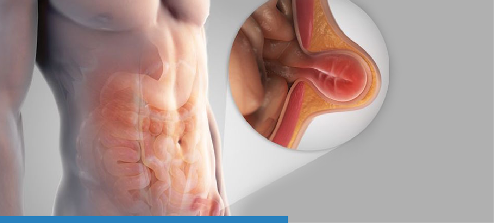 Βουβονοκήλη 5