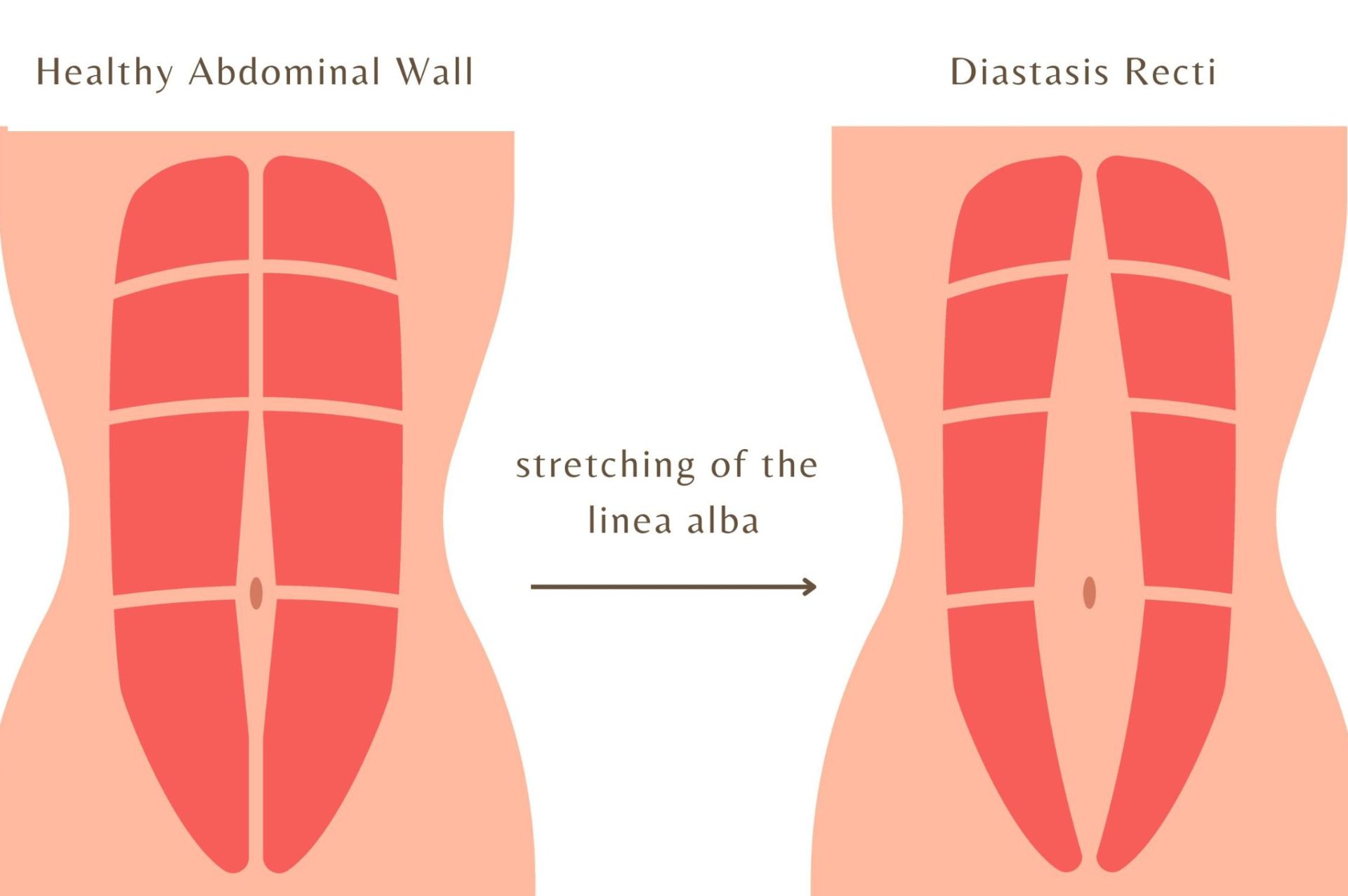 Διάσταση λευκής γραμμής vs επιγαστρική κήλη | Διαφορές & συνύπαρξη