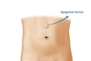 κήλη λευκής γραμμής