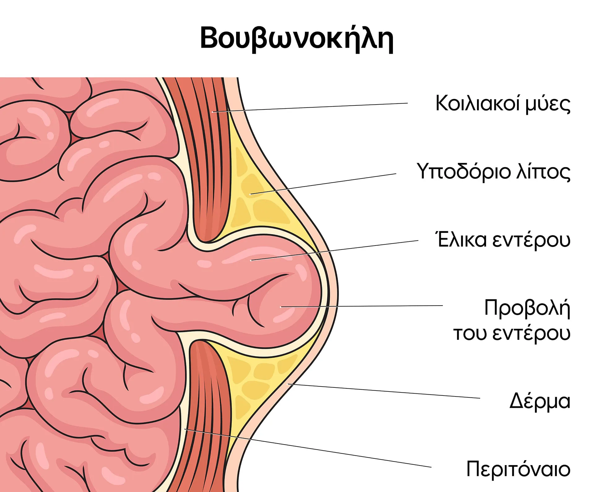 Τι είναι βουβωνοκήλη