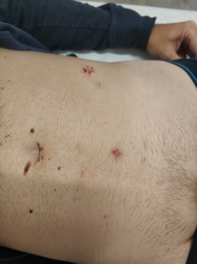 Ασθενής με αμφοτερόπλευρη βουβωνοκήλη αμέσως μετά το χειρουργείο.