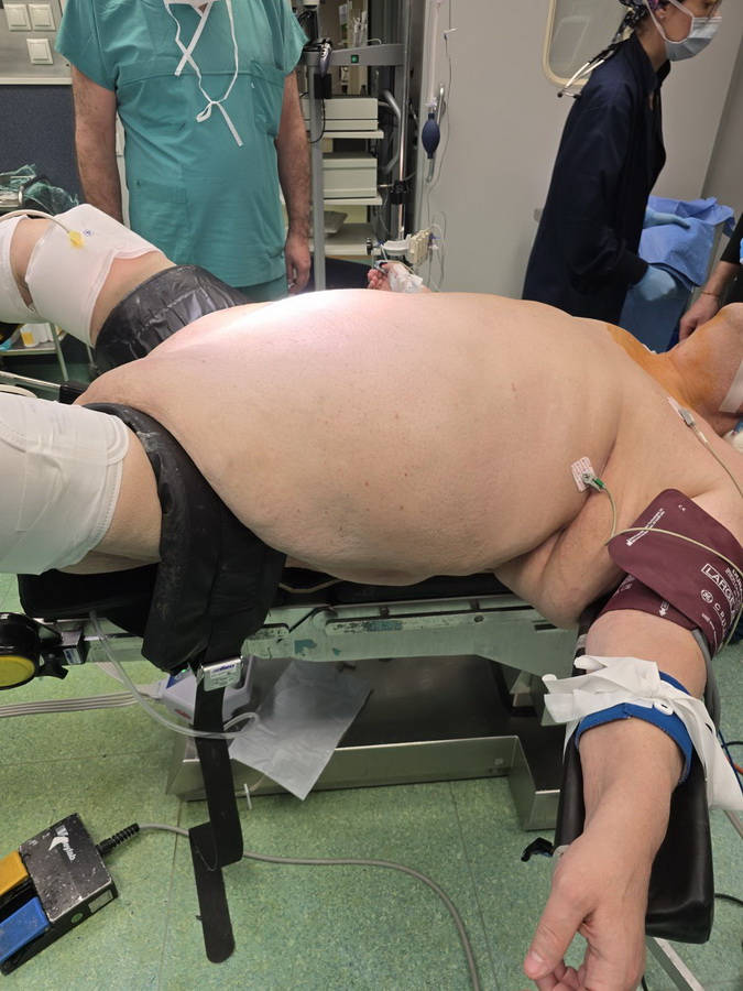 Ρομποτική αποκατάσταση μεγάλης βουβωνοκήλης.